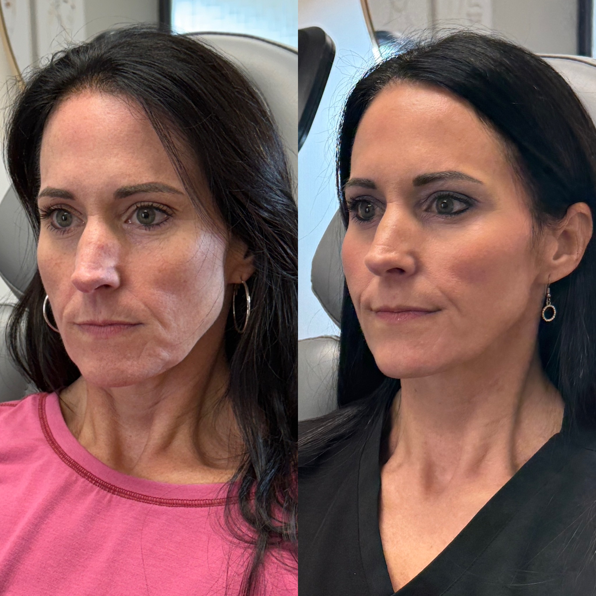 Harmonia Wellness and Aesthetics patient result 2