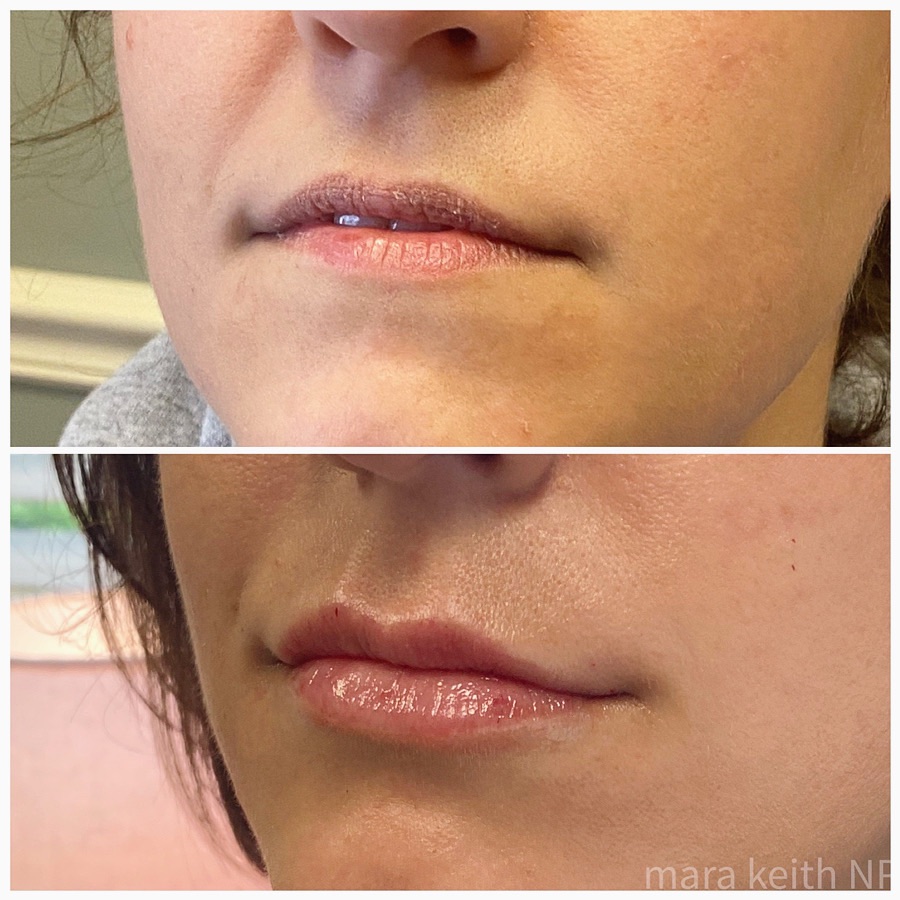 Harmonia Wellness and Aesthetics patient result 1