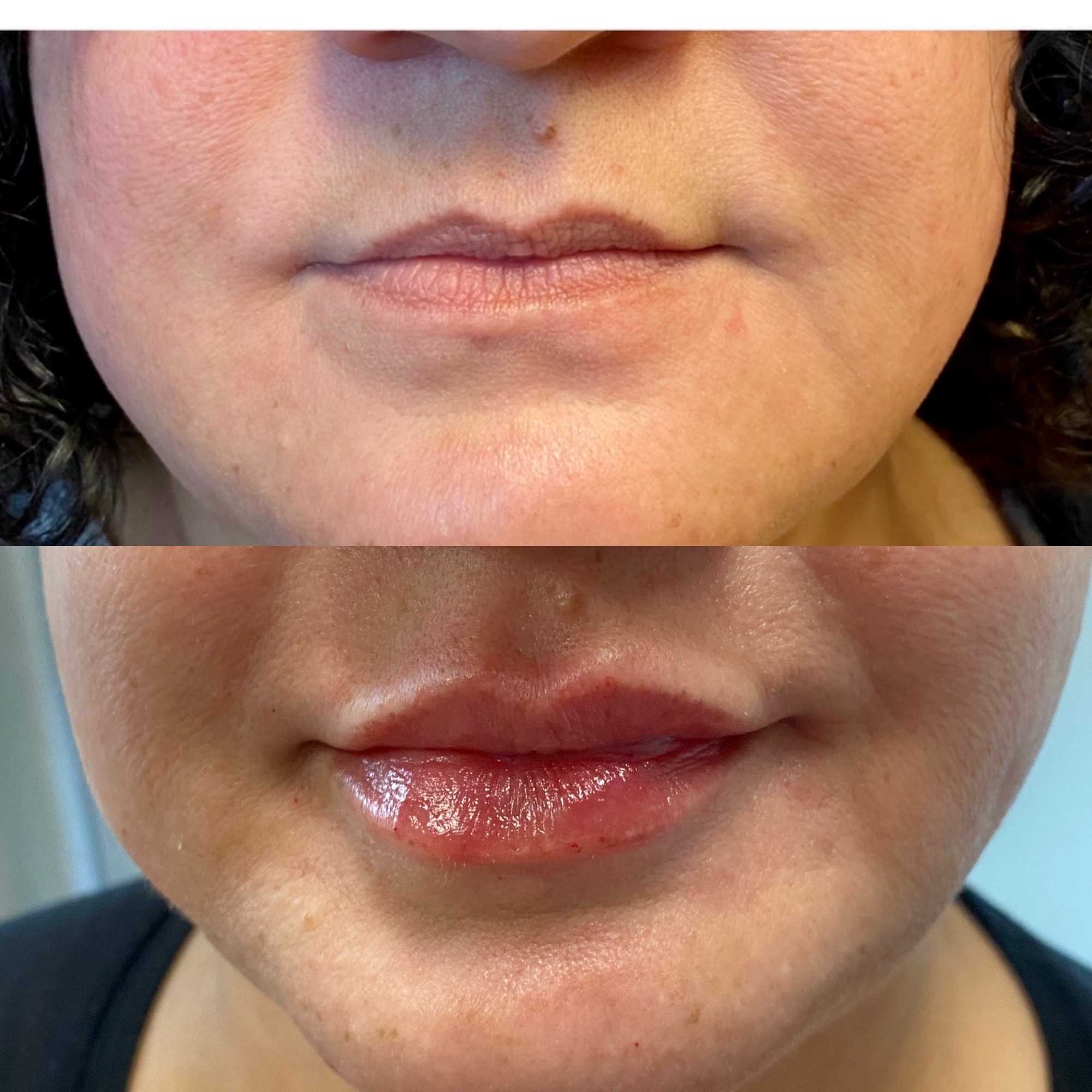 Harmonia Wellness and Aesthetics patient result 11